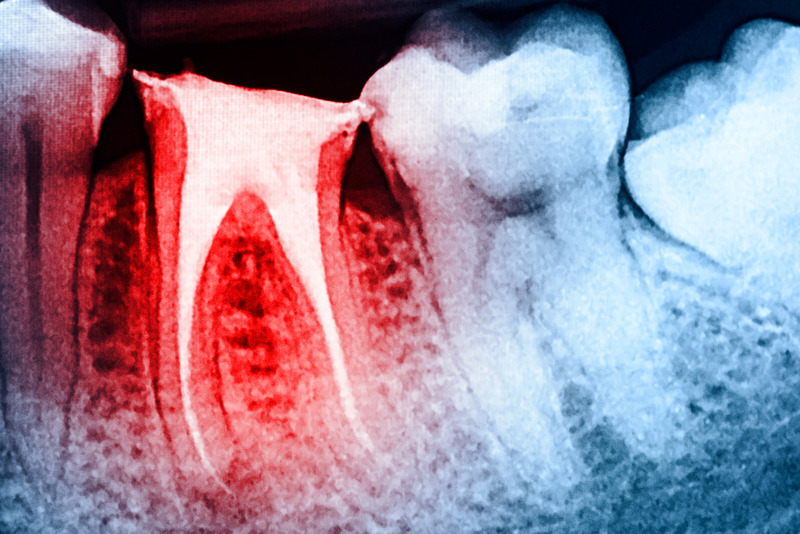 root canal treatment in Burbank